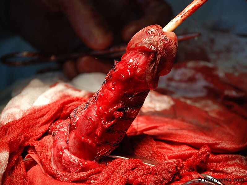 namestitev kolagenske matrice za povečanje penisa