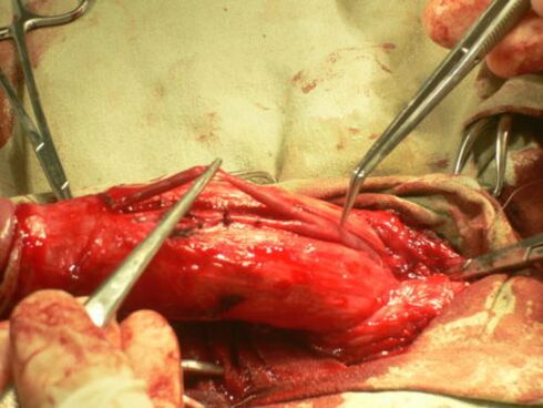 izvajanje operacije za povečanje penisa