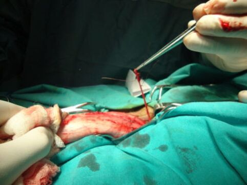 operacija povečanja penisa