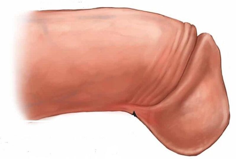 kako povečati glavico penisa